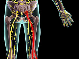 Can bad posture cause sciatica