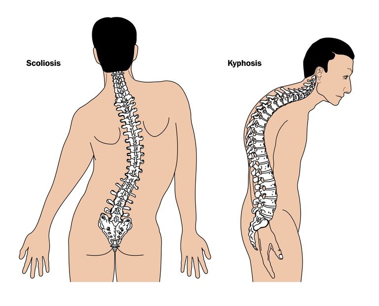 effects of poor posture on health